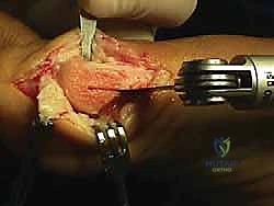 صورة طبية: جراحة ورم إبهام القدم الأروح المتقدم: تقنية شفرون ثنائية المستوى مع الأستاذ الدكتور محمد هطيف