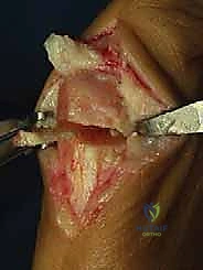 صورة طبية: جراحة ورم إبهام القدم الأروح المتقدم: تقنية شفرون ثنائية المستوى مع الأستاذ الدكتور محمد هطيف