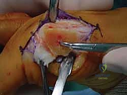 صورة طبية: جراحة ورم إبهام القدم الأروح المتقدم: تقنية شفرون ثنائية المستوى مع الأستاذ الدكتور محمد هطيف