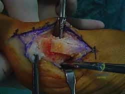 خطوة جراحية دقيقة