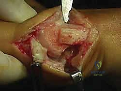 صورة طبية: جراحة ورم إبهام القدم الأروح المتقدم: تقنية شفرون ثنائية المستوى مع الأستاذ الدكتور محمد هطيف