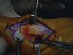 صورة طبية: جراحة ورم إبهام القدم الأروح المتقدم: تقنية شفرون ثنائية المستوى مع الأستاذ الدكتور محمد هطيف