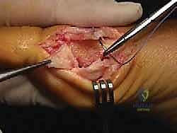 صورة طبية: جراحة ورم إبهام القدم الأروح المتقدم: تقنية شفرون ثنائية المستوى مع الأستاذ الدكتور محمد هطيف