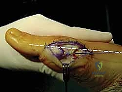 صورة طبية: جراحة ورم إبهام القدم الأروح المتقدم: تقنية شفرون ثنائية المستوى مع الأستاذ الدكتور محمد هطيف