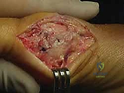 صورة طبية: جراحة ورم إبهام القدم الأروح المتقدم: تقنية شفرون ثنائية المستوى مع الأستاذ الدكتور محمد هطيف