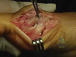 صورة طبية: جراحة ورم إبهام القدم الأروح المتقدم: تقنية شفرون ثنائية المستوى مع الأستاذ الدكتور محمد هطيف