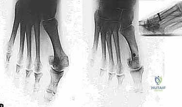 صورة طبية: جراحة ورم إبهام القدم الأروح المتقدم: تقنية شفرون ثنائية المستوى مع الأستاذ الدكتور محمد هطيف