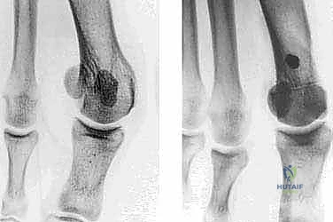 صورة طبية: جراحة ورم إبهام القدم الأروح المتقدم: تقنية شفرون ثنائية المستوى مع الأستاذ الدكتور محمد هطيف