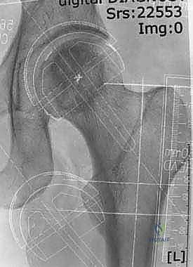 تقييم زوايا المفصل