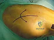 تشريح مفصل الورك وتآكل الغضاريف