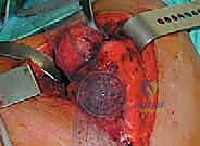 الفرق بين الاستبدال الكامل واستبدال السطح