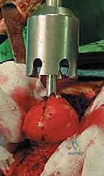 صورة طبية: استبدال سطح مفصل الورك: حل متطور لآلام الورك واستعادة النشاط مع الأستاذ الدكتور محمد هطيف