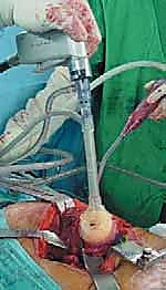 صورة طبية: استبدال سطح مفصل الورك: حل متطور لآلام الورك واستعادة النشاط مع الأستاذ الدكتور محمد هطيف