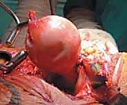 صورة توضيحية لـ استبدال سطح مفصل الورك: حل متطور لآلام الورك واستعادة النشاط مع الأستاذ الدكتور محمد هطيف