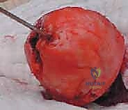 نحت رأس عظمة الفخذ