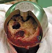 صورة طبية: استبدال سطح مفصل الورك: حل متطور لآلام الورك واستعادة النشاط مع الأستاذ الدكتور محمد هطيف