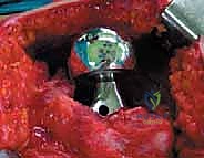 صورة طبية: استبدال سطح مفصل الورك: حل متطور لآلام الورك واستعادة النشاط مع الأستاذ الدكتور محمد هطيف