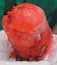 صورة طبية: استبدال سطح مفصل الورك: حل متطور لآلام الورك واستعادة النشاط مع الأستاذ الدكتور محمد هطيف