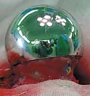 العودة للمشي الطبيعي