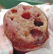 الوصول إلى مفصل الورك