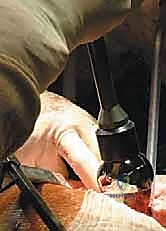 صورة طبية: استبدال سطح مفصل الورك: حل متطور لآلام الورك واستعادة النشاط مع الأستاذ الدكتور محمد هطيف