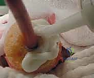 مقارنة الغرسات الطبية