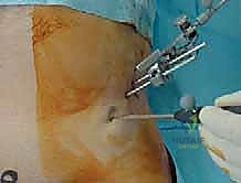 صورة توضيحية لـ استبدال سطح مفصل الورك: حل متطور لآلام الورك واستعادة النشاط مع الأستاذ الدكتور محمد هطيف