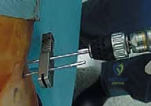 صورة طبية: استبدال سطح مفصل الورك: حل متطور لآلام الورك واستعادة النشاط مع الأستاذ الدكتور محمد هطيف