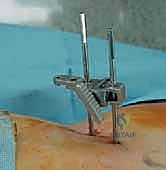 فصل رأس الفخذ عن الحُق