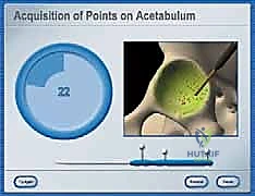 صورة توضيحية لـ استبدال سطح مفصل الورك: حل متطور لآلام الورك واستعادة النشاط مع الأستاذ الدكتور محمد هطيف