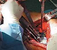 صورة طبية: استبدال سطح مفصل الورك: حل متطور لآلام الورك واستعادة النشاط مع الأستاذ الدكتور محمد هطيف