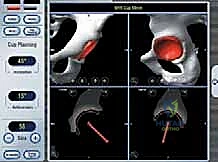 آثار النخر اللاوعائي على عظمة الفخذ