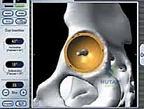 إبعاد العضلات برفق