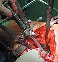 زرع الوعاء المعدني في الحوض