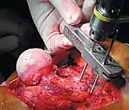 تنظيف تجويف الحُق