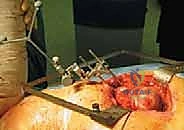 شكل المفصل بعد الاستبدال السطحي