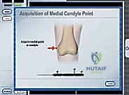 صورة توضيحية لـ استبدال سطح مفصل الورك: حل متطور لآلام الورك واستعادة النشاط مع الأستاذ الدكتور محمد هطيف