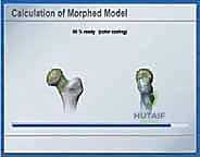 صورة طبية: استبدال سطح مفصل الورك: حل متطور لآلام الورك واستعادة النشاط مع الأستاذ الدكتور محمد هطيف