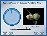 صورة طبية: استبدال سطح مفصل الورك: حل متطور لآلام الورك واستعادة النشاط مع الأستاذ الدكتور محمد هطيف