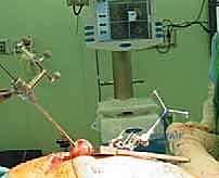 صورة توضيحية لـ استبدال سطح مفصل الورك: حل متطور لآلام الورك واستعادة النشاط مع الأستاذ الدكتور محمد هطيف