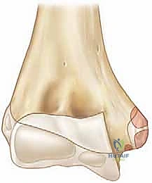 توضيح طبي: كسر اللقيمة الإنسية بالمرفق: دليل شامل للعلاج الجراحي والتعافي مع الأستاذ الدكتور محمد هطيف