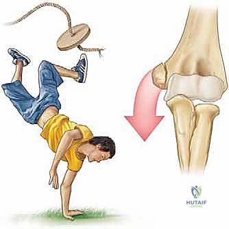 توضيح طبي: كسر اللقيمة الإنسية بالمرفق: دليل شامل للعلاج الجراحي والتعافي مع الأستاذ الدكتور محمد هطيف