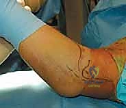 توضيح طبي: كسر اللقيمة الإنسية بالمرفق: دليل شامل للعلاج الجراحي والتعافي مع الأستاذ الدكتور محمد هطيف