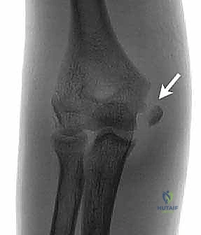 توضيح طبي: كسر اللقيمة الإنسية بالمرفق: دليل شامل للعلاج الجراحي والتعافي مع الأستاذ الدكتور محمد هطيف