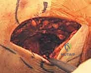 توضيح طبي: كسر اللقيمة الإنسية بالمرفق: دليل شامل للعلاج الجراحي والتعافي مع الأستاذ الدكتور محمد هطيف