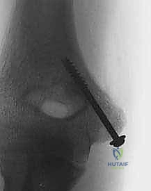 صورة توضيحية لـ كسر اللقيمة الإنسية بالمرفق: دليل شامل للعلاج الجراحي والتعافي مع الأستاذ الدكتور محمد هطيف