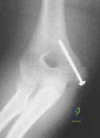 صورة توضيحية لـ كسر اللقيمة الإنسية بالمرفق: دليل شامل للعلاج الجراحي والتعافي مع الأستاذ الدكتور محمد هطيف