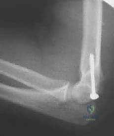 كسر اللقيمة الإنسية بالمرفق: دليل شامل للعلاج الجراحي والتعافي مع الأستاذ الدكتور محمد هطيف