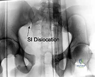 تفاصيل تشريحية للحوض أثناء الجراحة