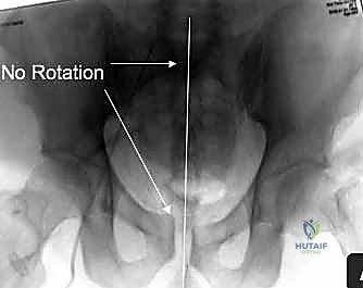 صورة توضيحية لـ جراحة الرد المفتوح والتثبيت الداخلي